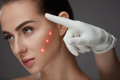 Laser Treatment